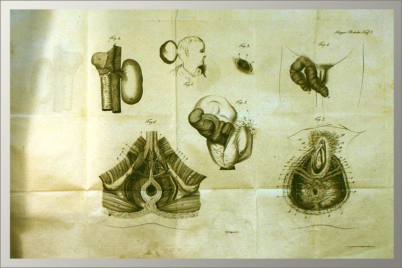 Die Brüche und Vorfälle beschrieben - EOS BUCHANTIQUARIAT BENZ Hager, Michael: -Die Brüche und Vorfälle beschrieben