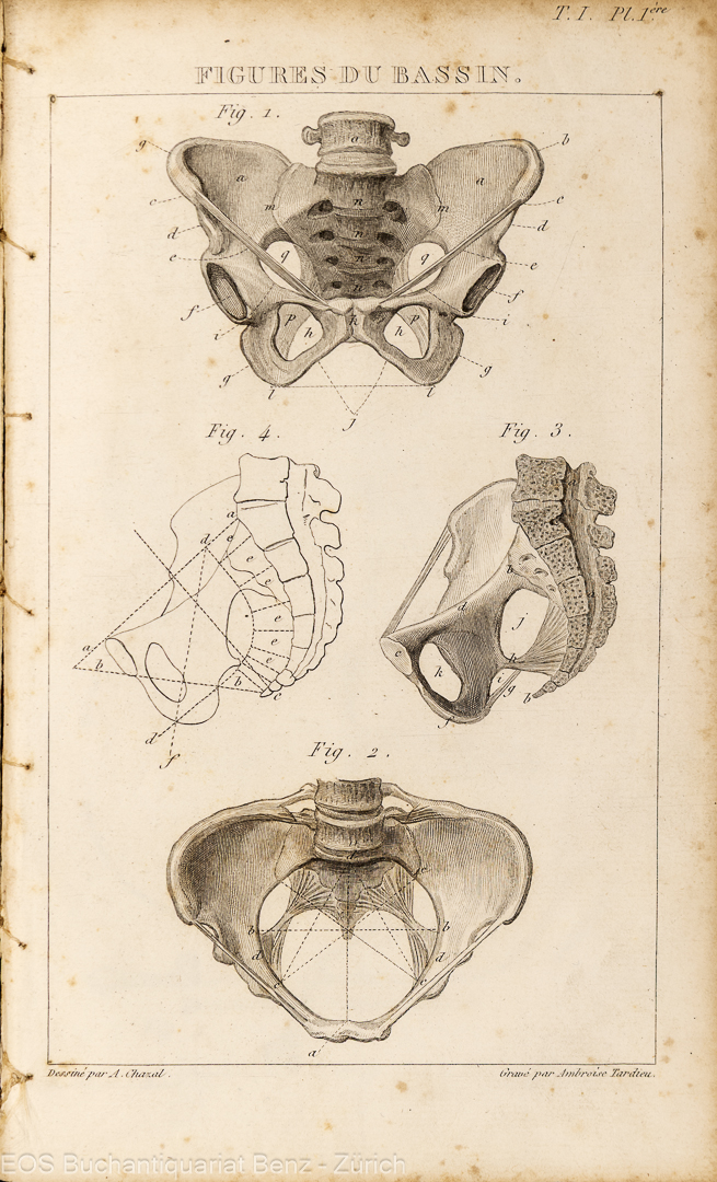 Velpeau, Alfred-Armand-Louis-Marie: Traité complet de l'art des accouchemens ou Tocologie théorique et pratique. - Image 2